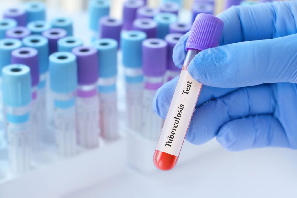 WHO sounds alarm on global tuberculosis crisis