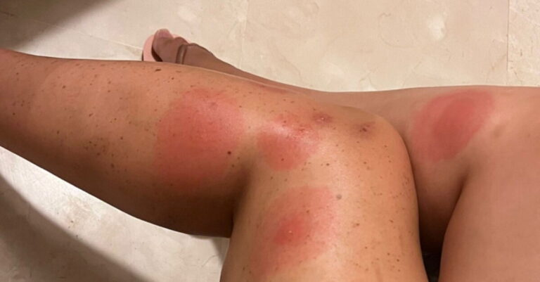 What you need to know about Skeeter syndrome