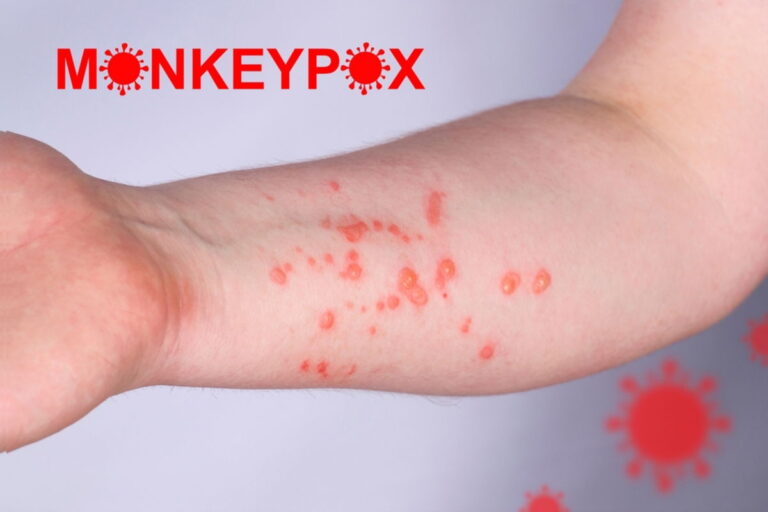 New Mpox case confirmed in Zaragoza